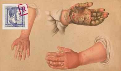 Rekommandert #86: Kjønnssykdommer